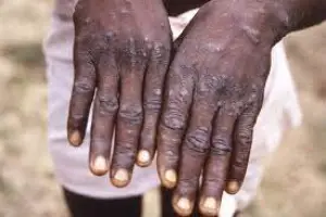 Variole du singe : les vaccins anti-Covid ont-ils un lien avec les contaminations par le monkeypox ?
